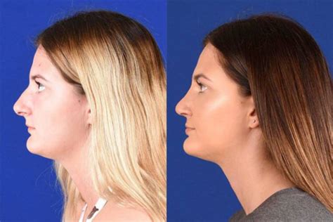 Shapiro performs a full range of facial plastic surgery procedures for cosmetic reasons as well as reconstructive procedures. . Dr shapiro rhinoplasty cost